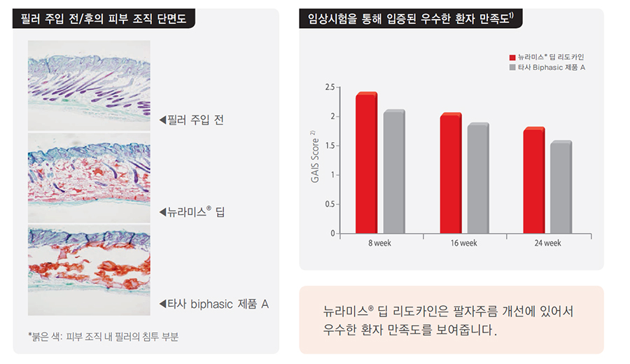 필러시술부위