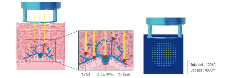 노블렉스 레이저제모